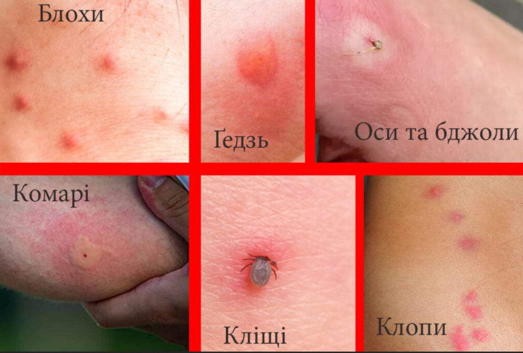 укуси комах фото